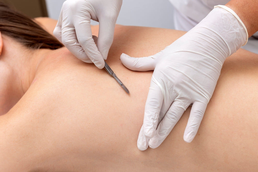 Dermaplaning