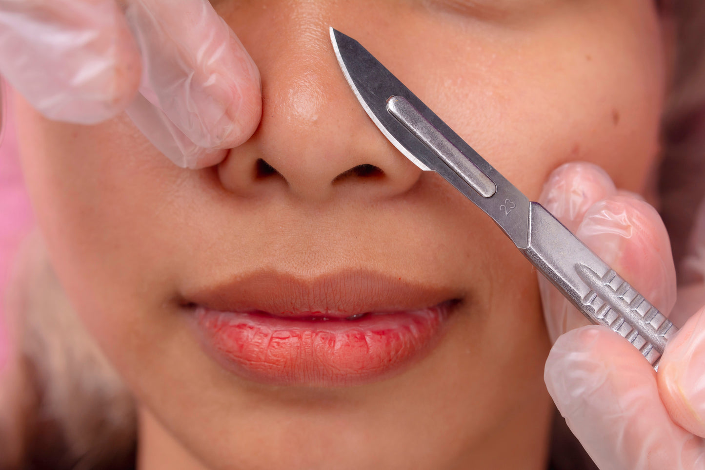 Dermaplaning